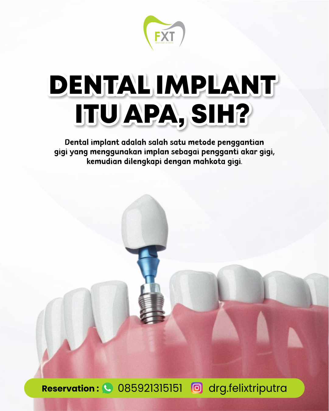 Dental Implant Itu Apa Sih?