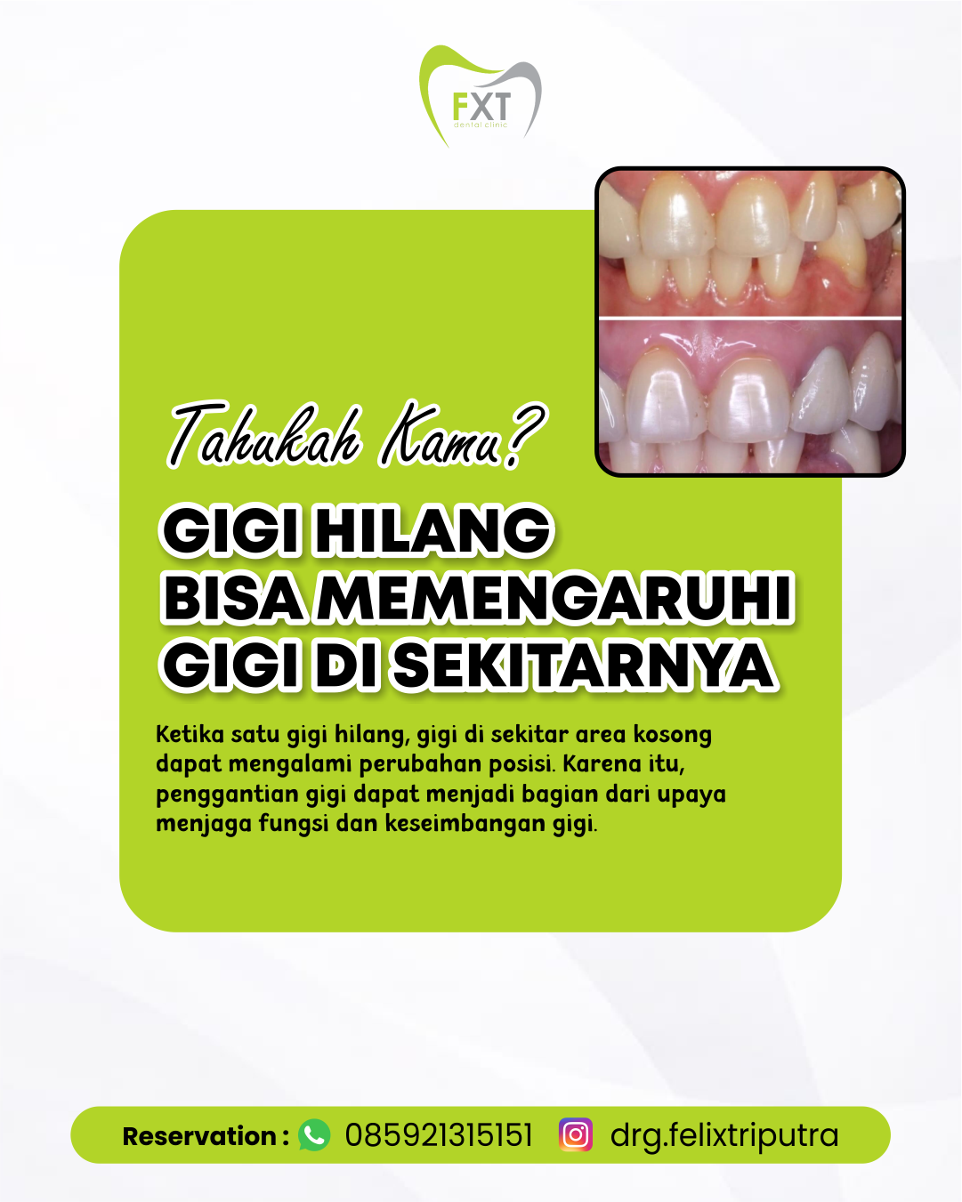 Gigi Hilang Bisa Memengaruhi Gigi Di Sekitarnya
