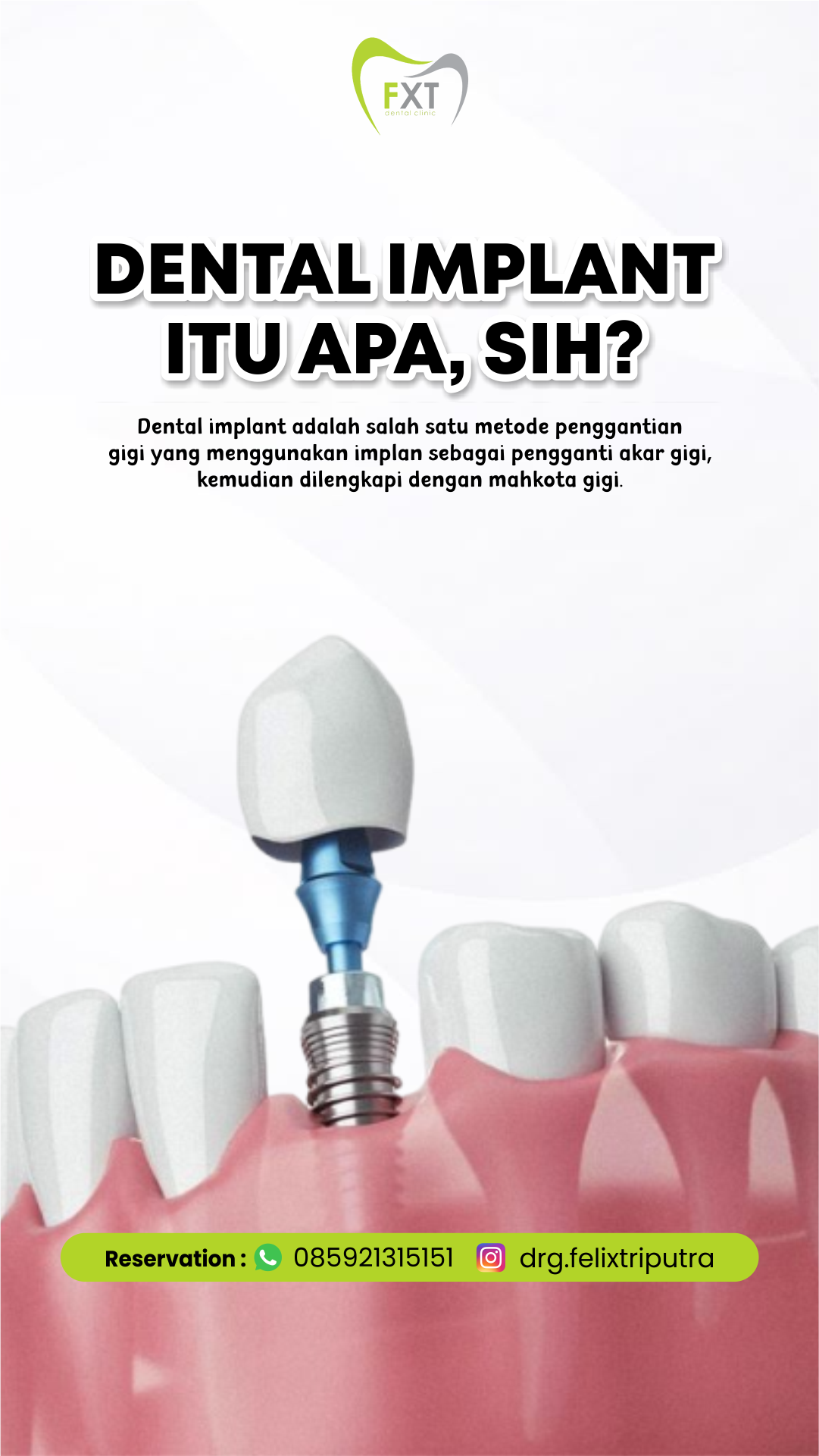 Mengenal Lebih Dalam Tentang Dental Implant