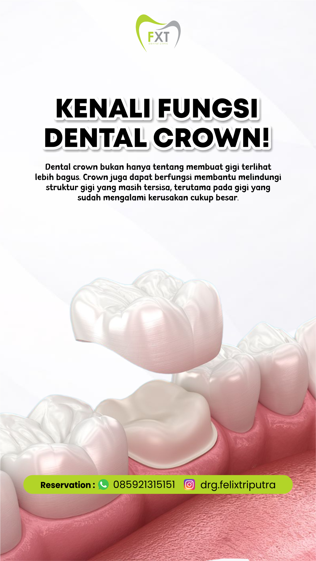 Fakta Penting Tentang Mahkota Gigi (Crown)