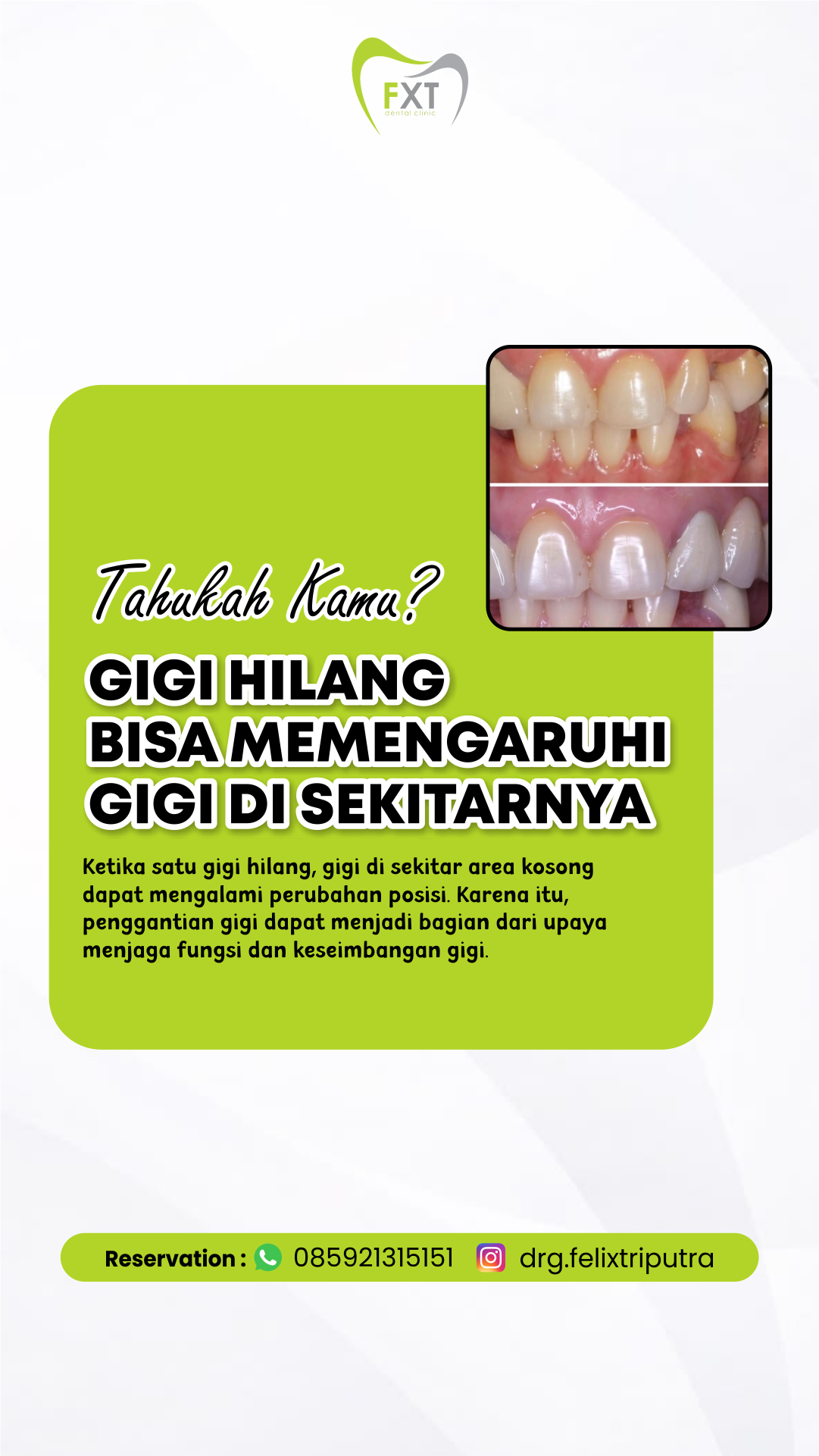 Bahaya Membiarkan Gigi Ompong Tanpa Diganti